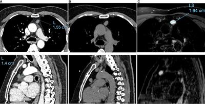 Intrathymic growing bronchogenic cyst mimicking thymoma: A case report